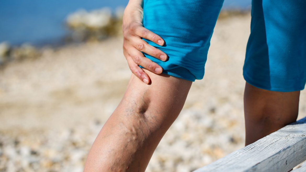 What Causes Vein Disease?