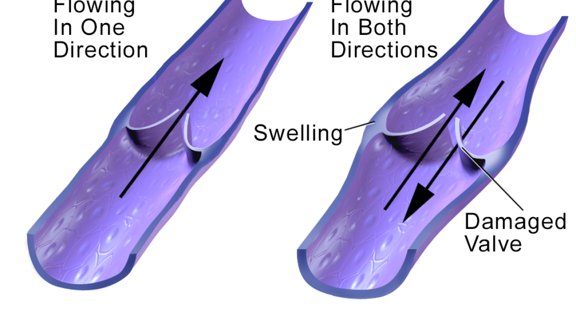 What is Chronic Venous Disease?